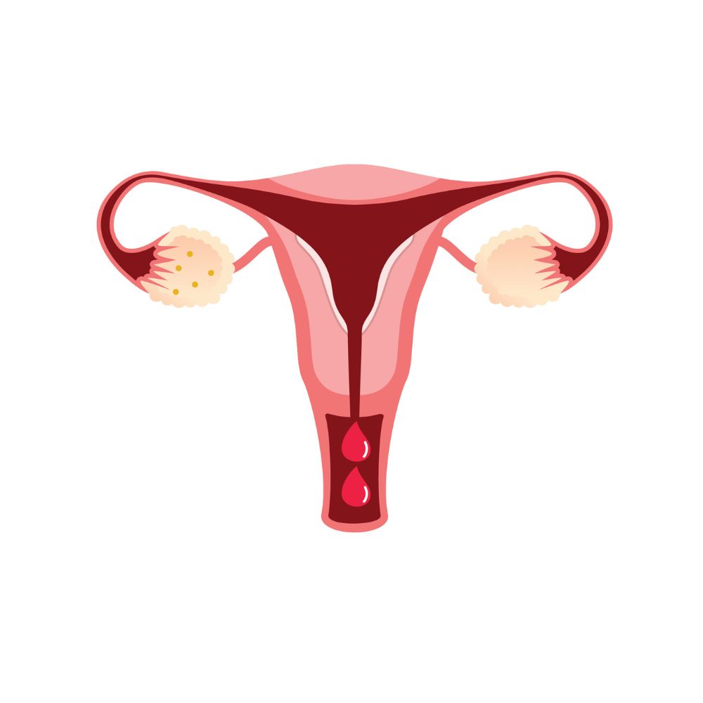 Dysfunctional Uterine Bleeding (DUB) | Uterine Bleeding