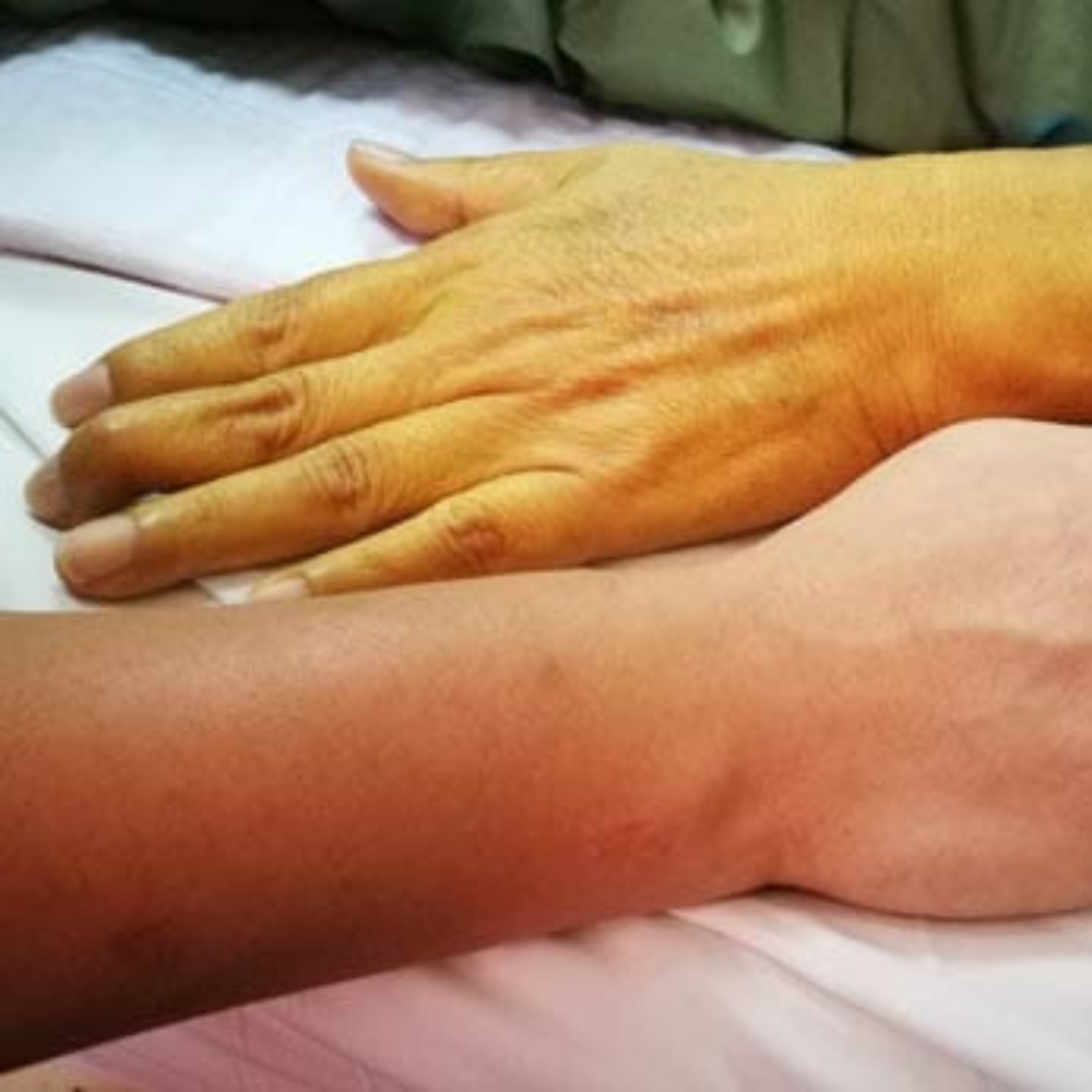 Jaundice | Jaundice Treatment | Chronic Jaundice