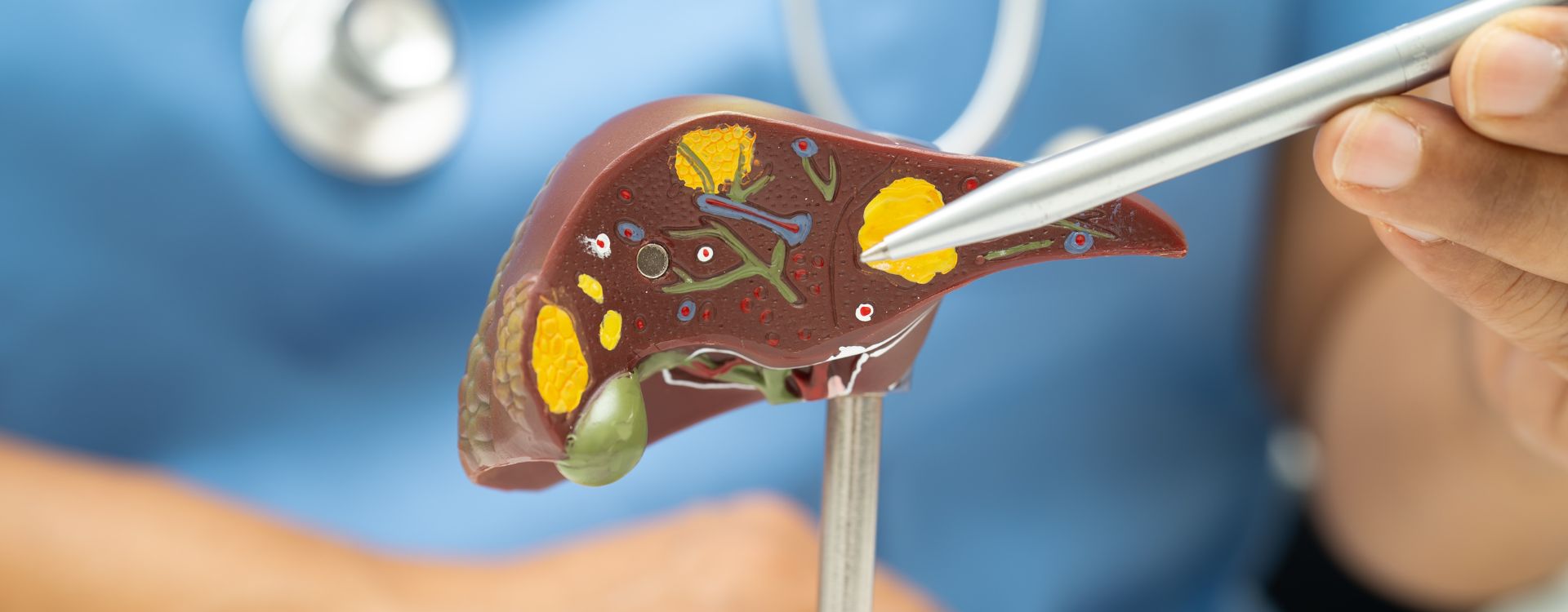 Herbs for fatty liver including milk thistle, kalmegh, kutki, and other natural herbal remedies