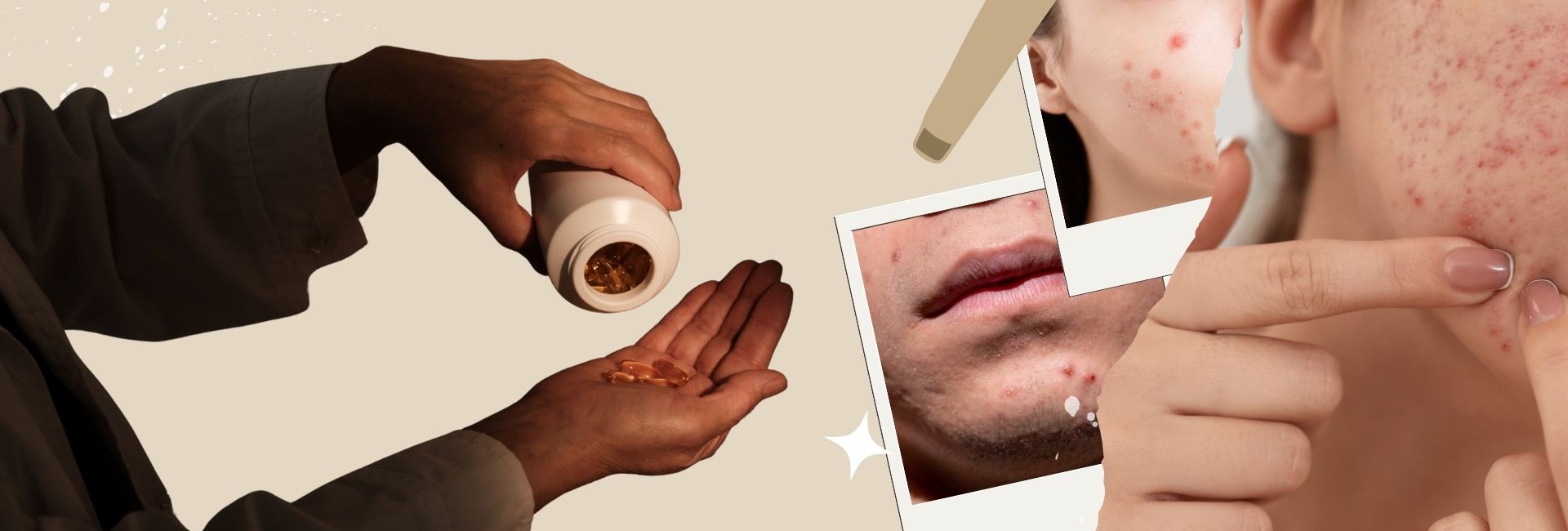 Illustration of acne vulgaris showing facial breakouts, inflamed pimples, and skin texture issues linked to Mukhadushika.