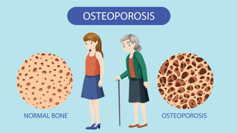 Osteoporosis prevention: What you should start doing today