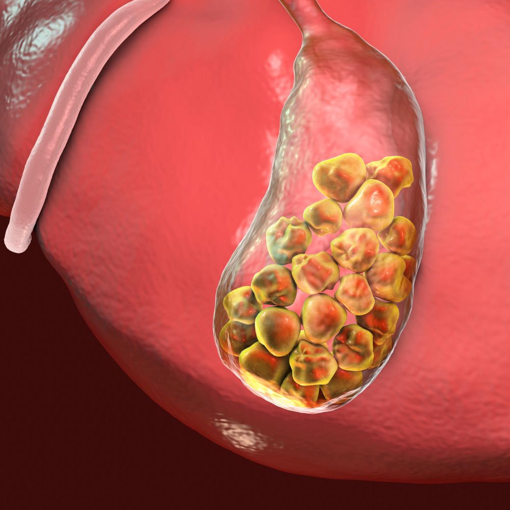 Gallstone | Gallbladder Stone Treatment | Gallbladder Pain