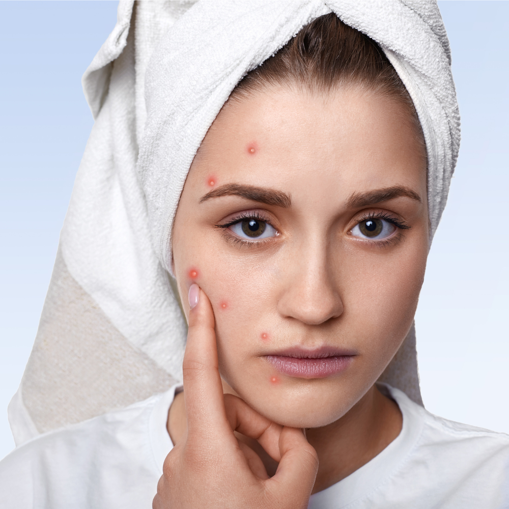 Mukhadushika (Pimple/Acne Vulgaris) | Pimple and Acne Treatments