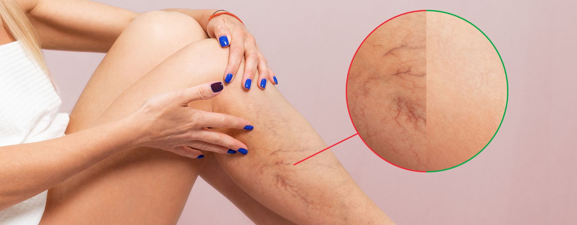 Natural treatment for blood clot in leg using home remedies and herbs to improve blood circulation and prevent deep vein thrombosis (DVT)