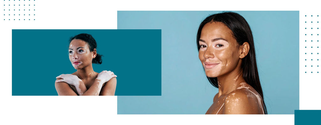Switra/Vitiligo: Causes, Symptoms & Effective Ayurvedic Management