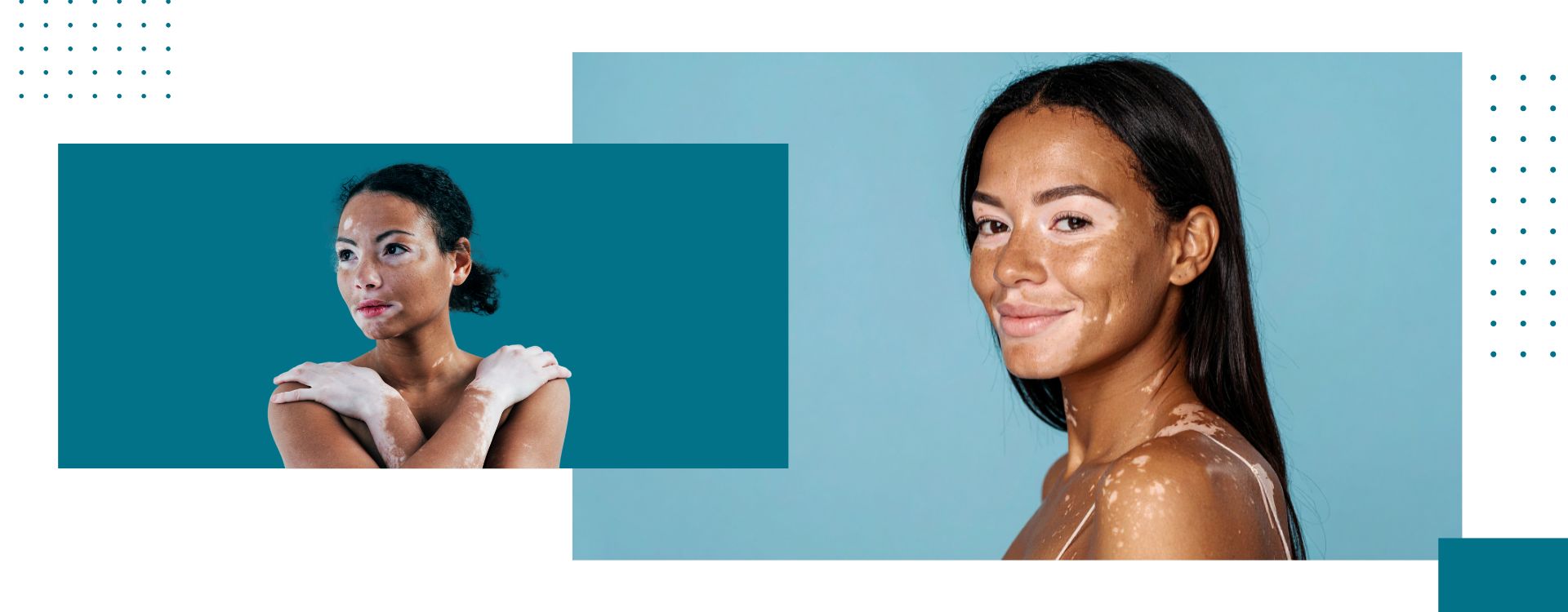 Illustration showing vitiligo white patches on skin, explaining causes, symptoms, diagnosis methods, and Ayurvedic treatment approaches.